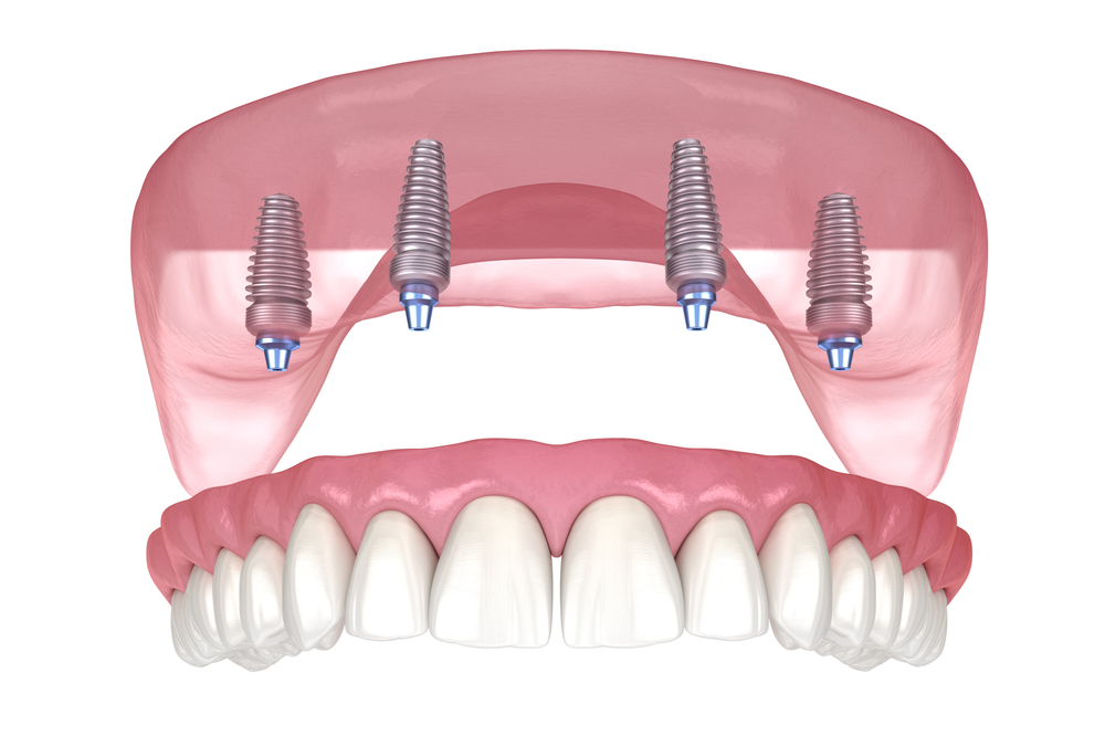 All on 4 system supported by implants. Medically accurate 3D illustration of human teeth and dentures