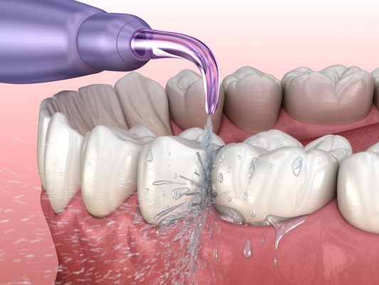 water pick cleans between teeth better than normal flossing