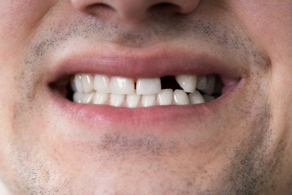 man shows off missing tooth