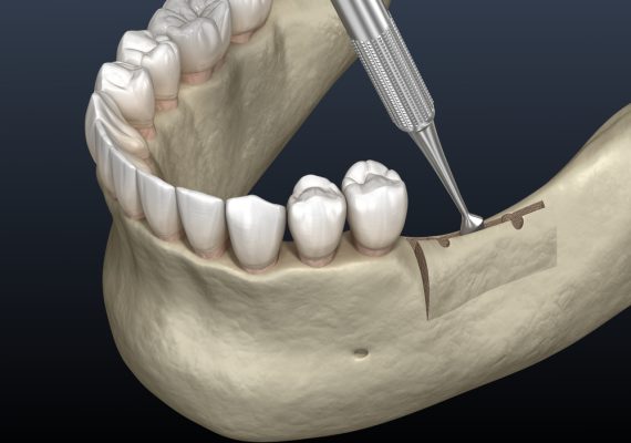 3d render of ridge augmentation surgery