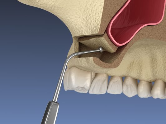 sinus membrane being moved during sinus lift procedure