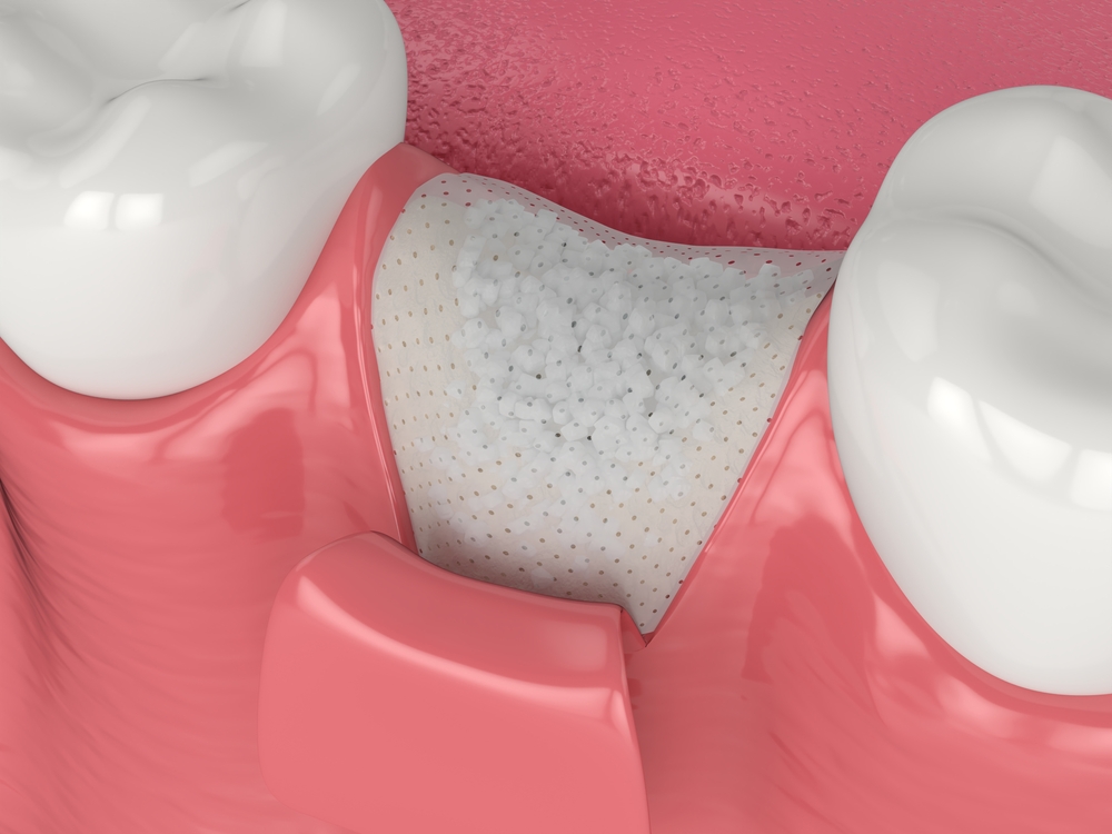 dental bone graft