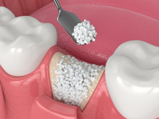 3d render of material being placed in bone grafting site