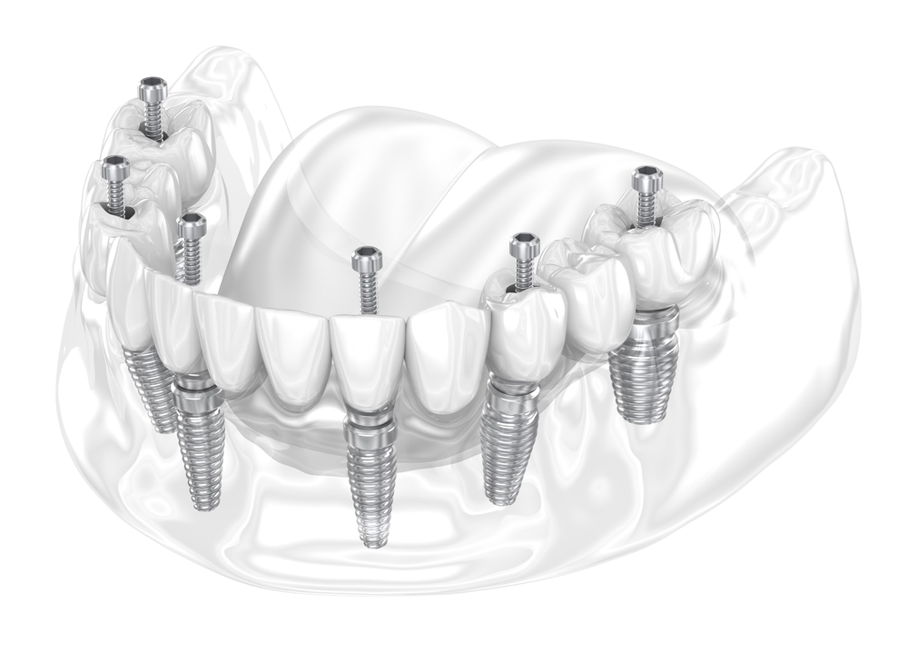 dental proshthesis supportedprosthesis by six dental implants