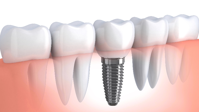 single tooth dental implant