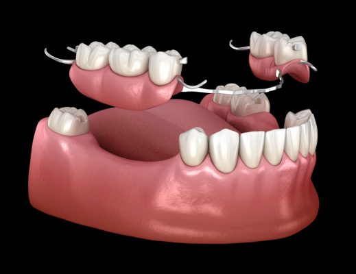 removable partial dentures