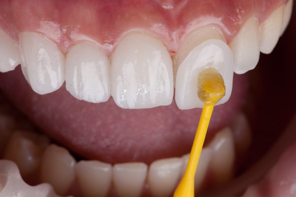 dental veneer shown over top of natural tooth