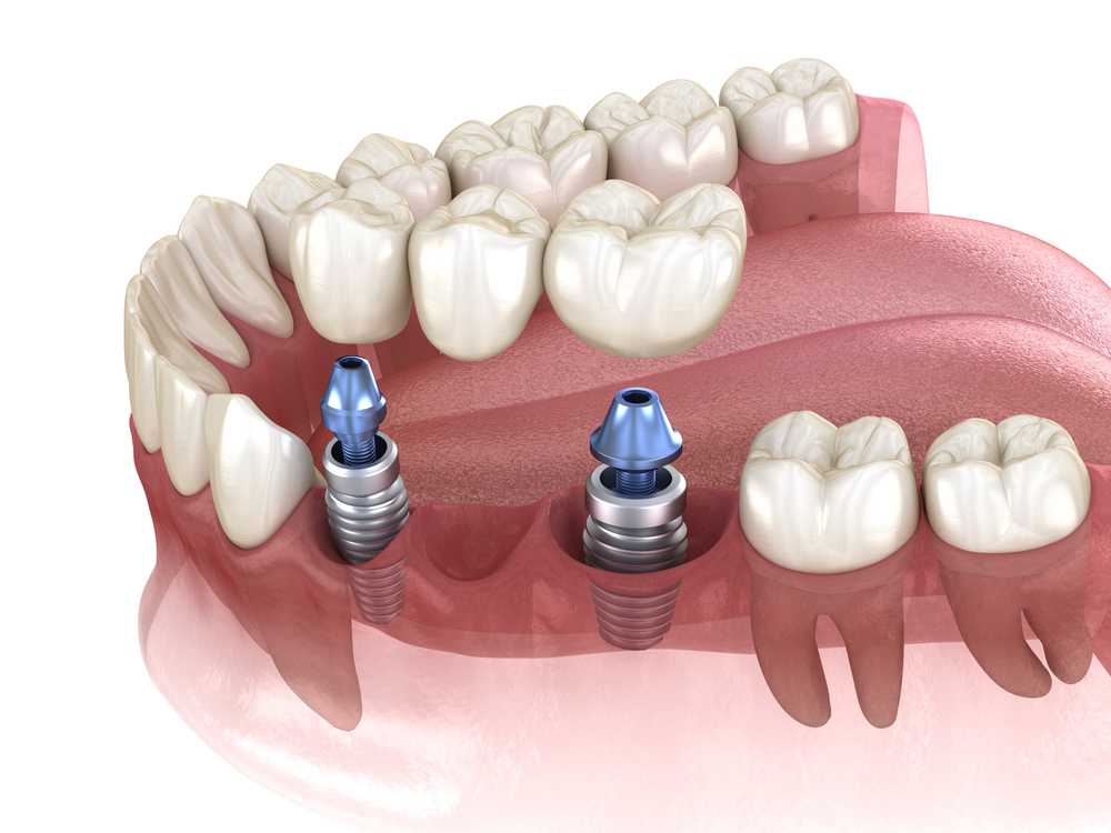 implant-supported bridge