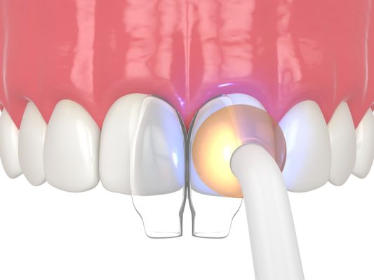 dental bonding material being set