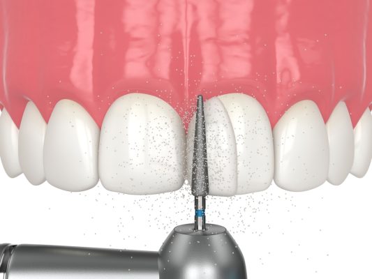 dental bonding material being shaped