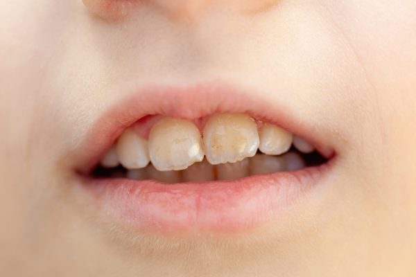 tooth enamel erosion