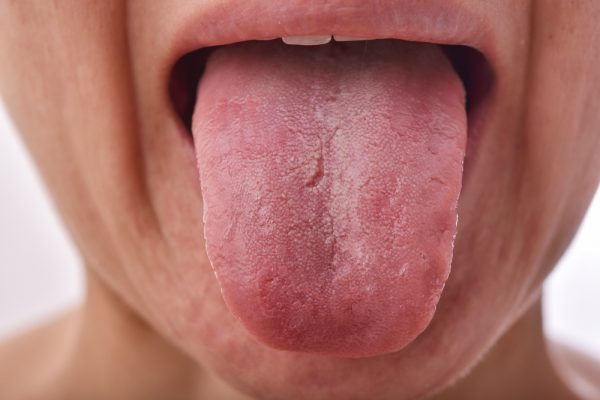 textured tongue problems