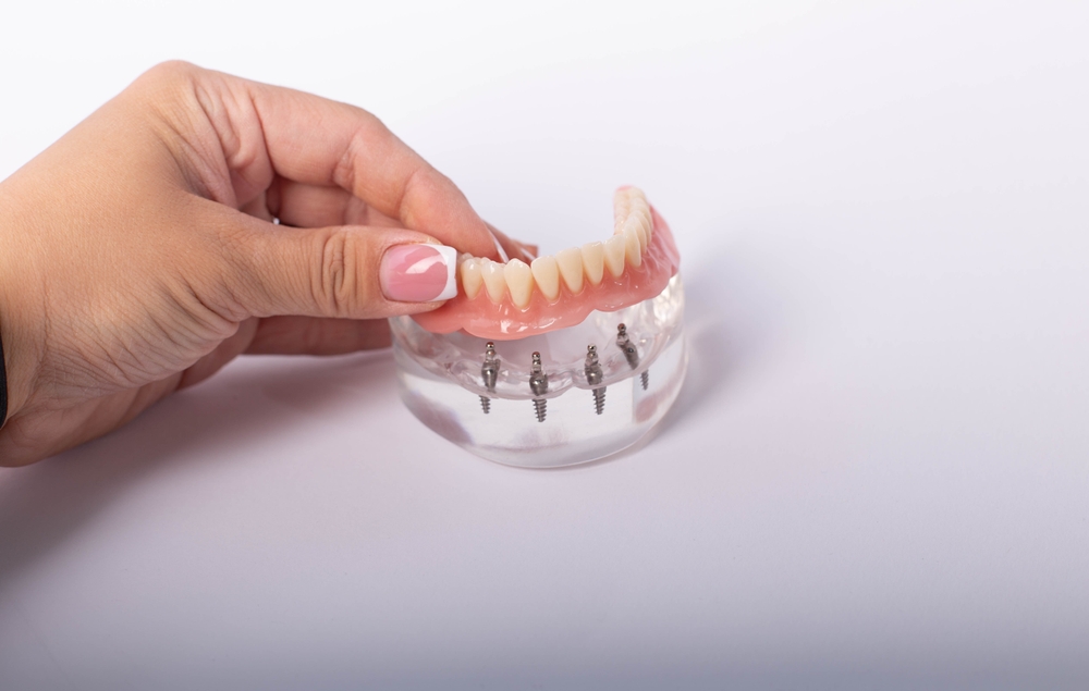 all-on-four dental implants display